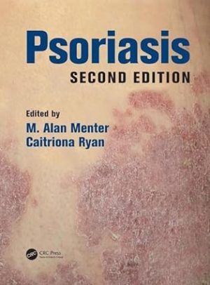 Psoriasis 2nd Edition