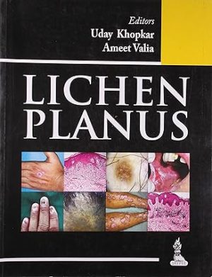 Lichen Planus