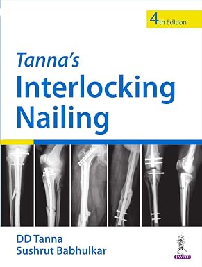 Tannas Interlocking Nailing 4th Edition