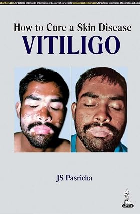 How to Cure a Skin Disease Vitiligo