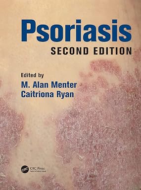 Psoriasis 2nd Edition