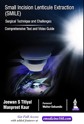 Small Incision Lenticule Extraction Smile Surgical Technique and Challenges