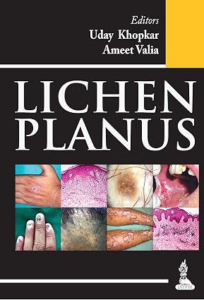 Lichen Planus